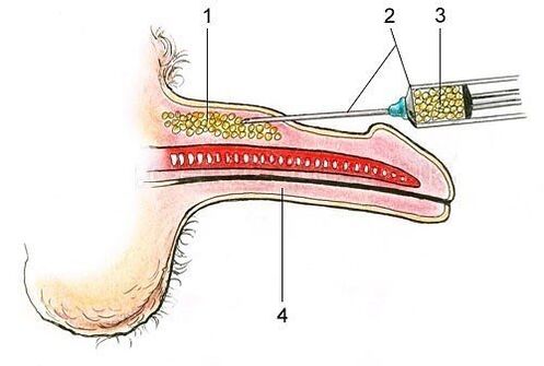 Introduction du tissu adipeux sous la peau du pénis